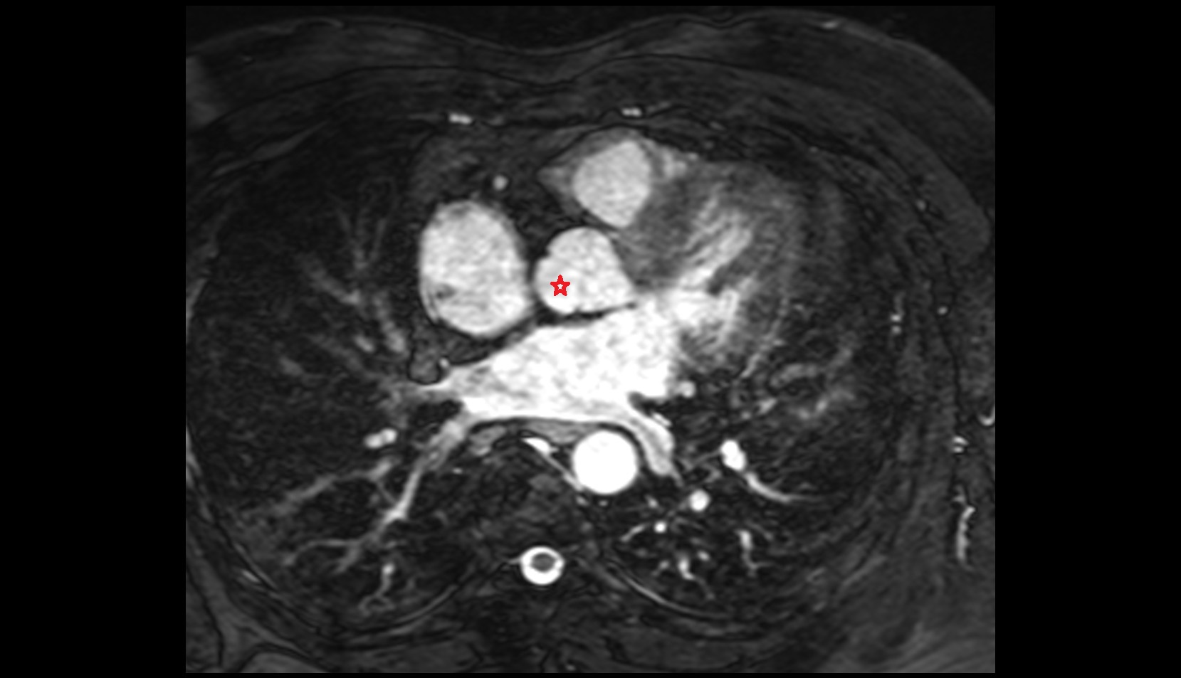 Noncoronary aortic sinus MRI axial image
