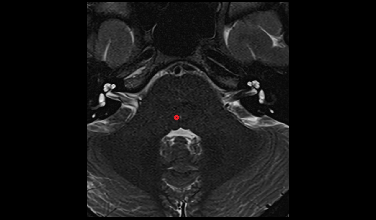 Nucleus of abducens nerve mri 3t image