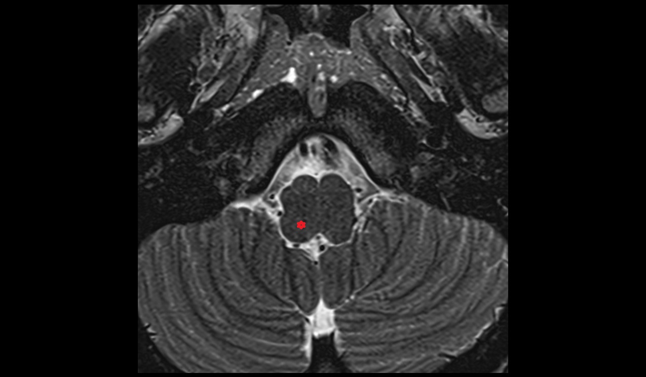 Nucleus of solitary tract