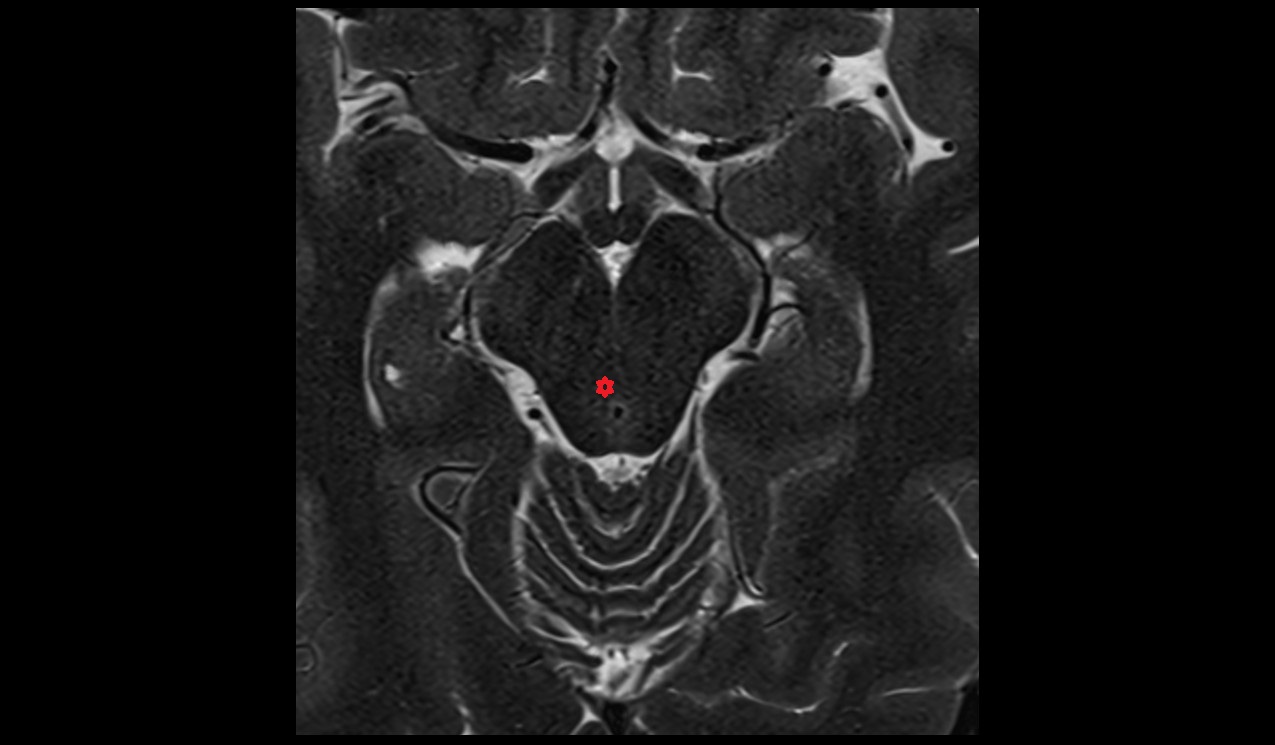 Nucleus of trochlear nerve MRI 3T image