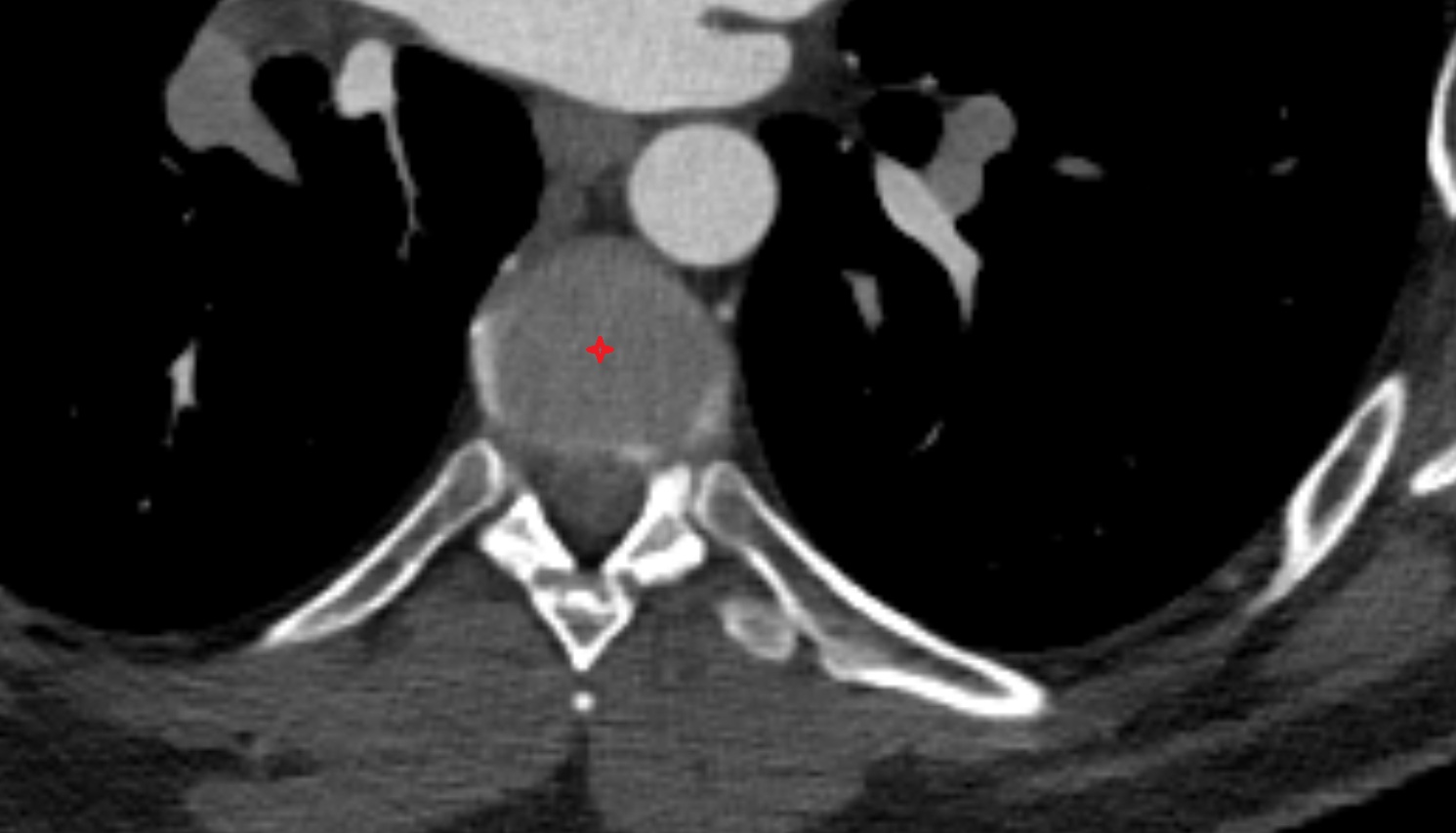 Nucleus pulposus of Intervertebral disc ct coronal  image -img-00000-00000