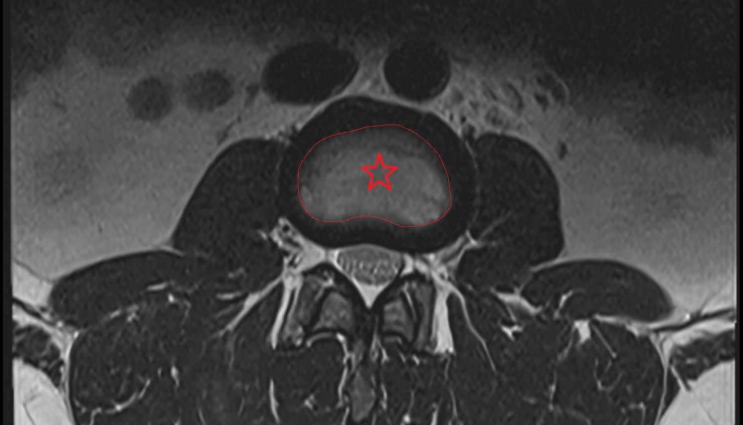Nucleus pulposus of intervertebral disc   MRI axial  anatomy  image-img-00000-00000