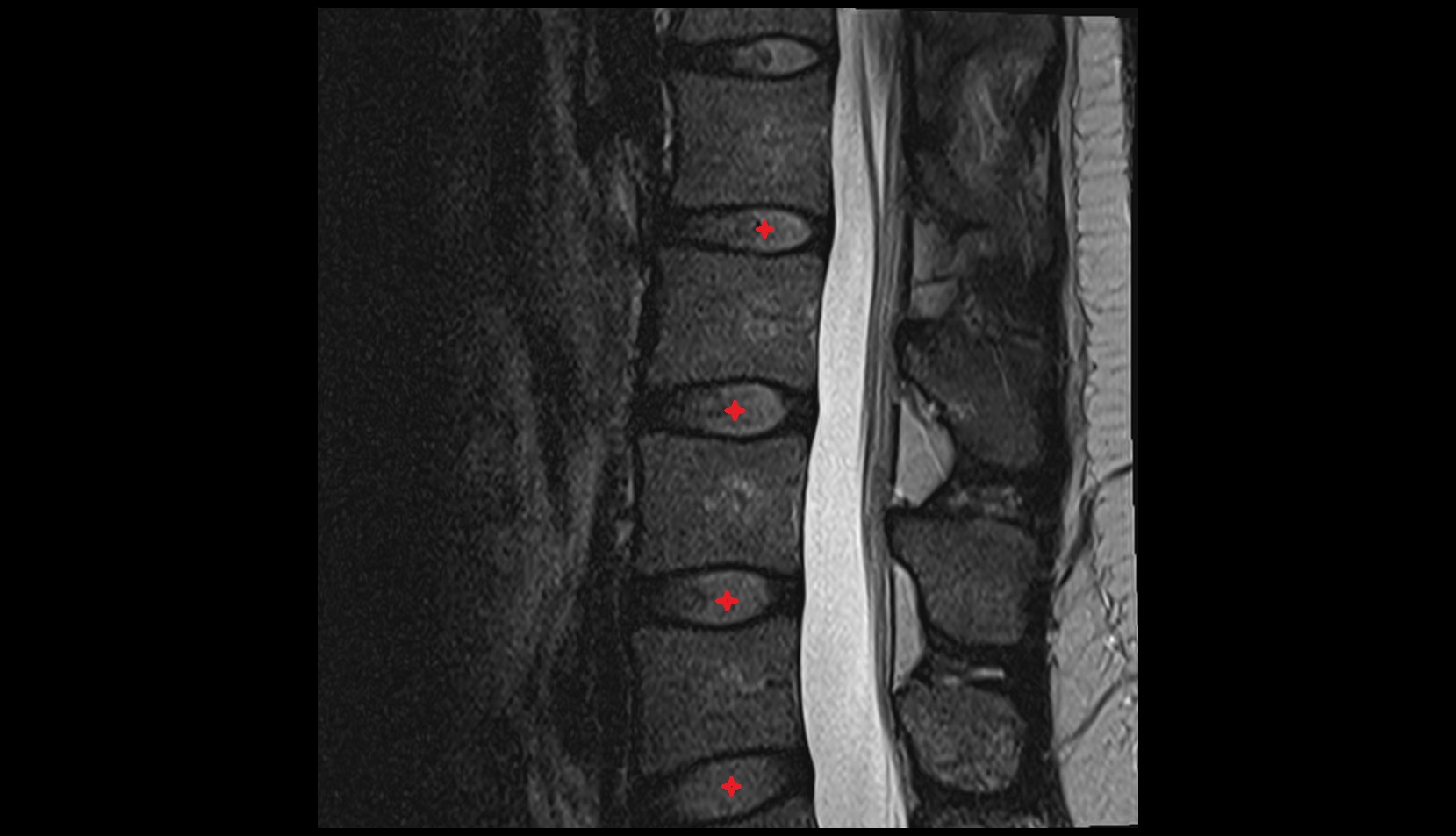 Nucleus pulposus of intervertebral disc sagittal image