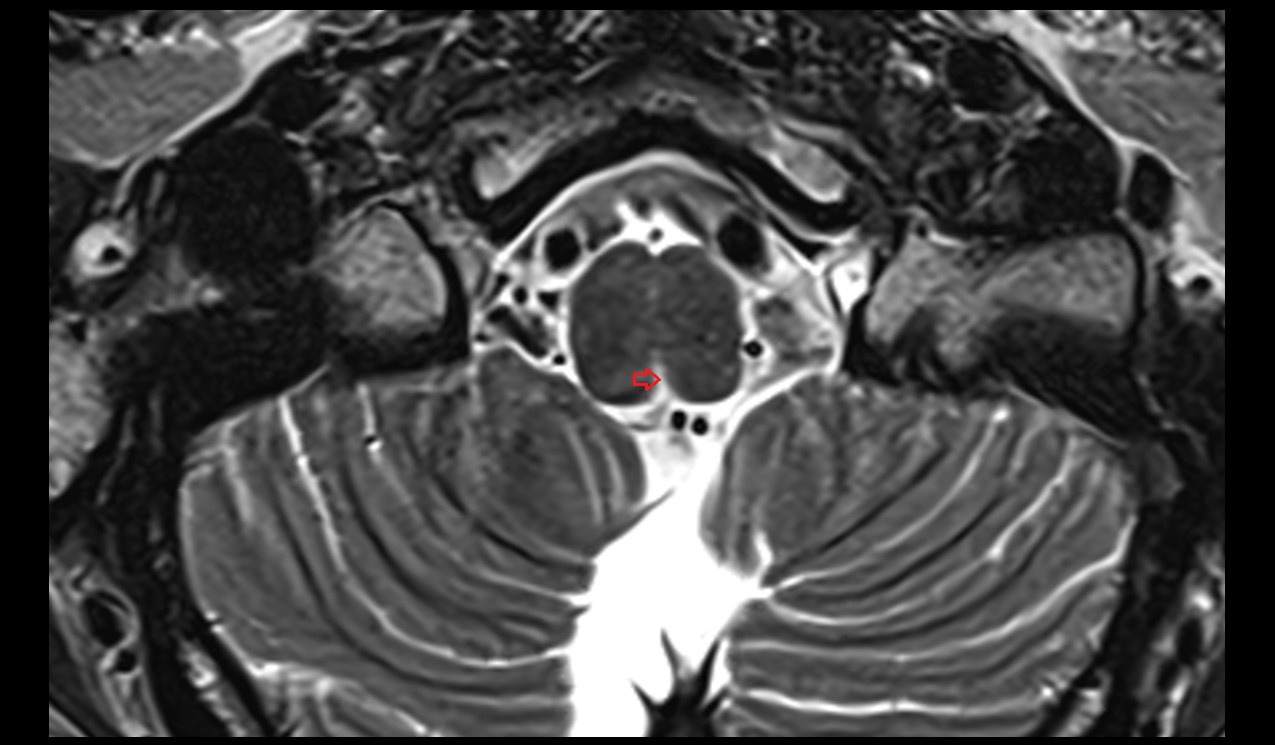 Obex (Gierke) mri 3t axial image
