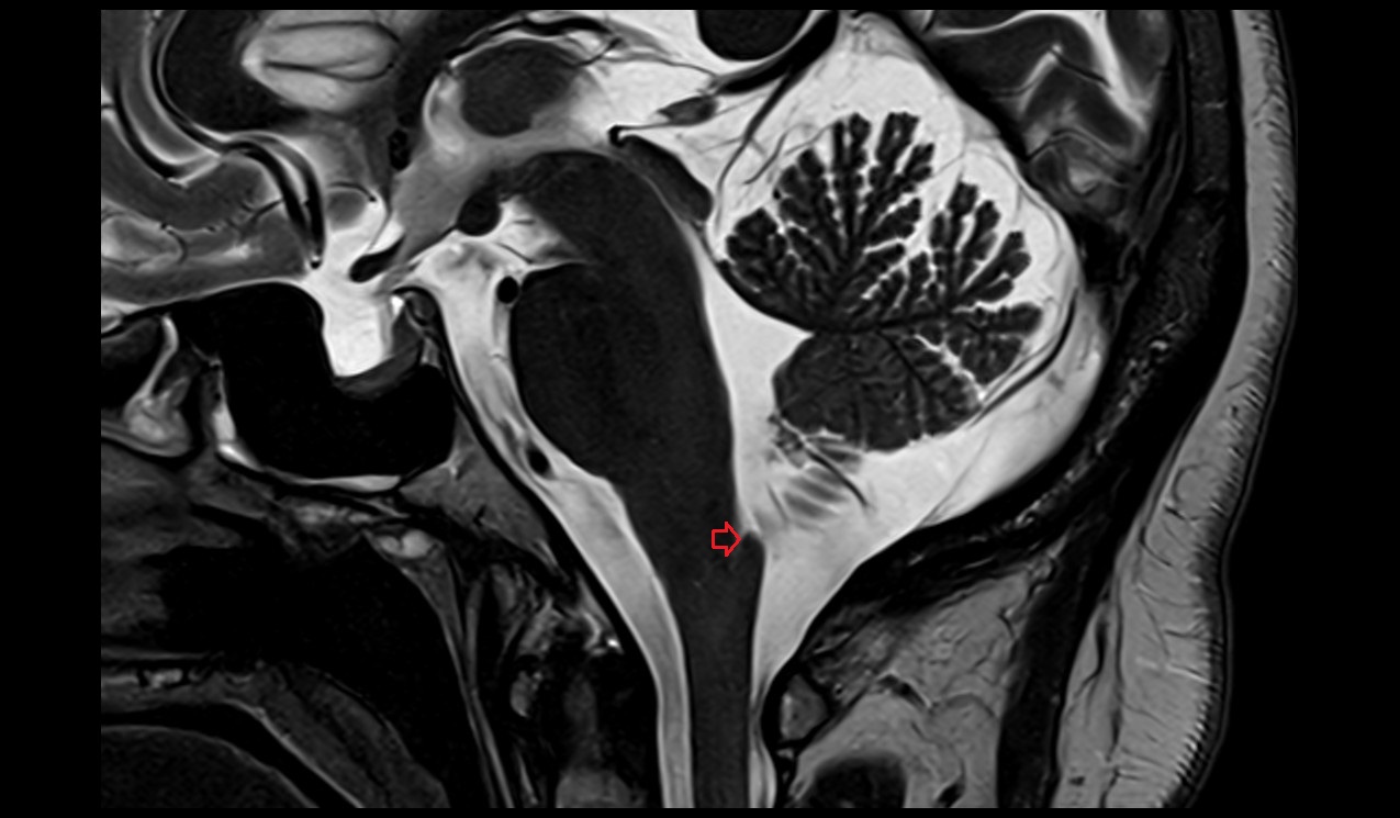 Obex (Gierke) mri 3t sagittal image