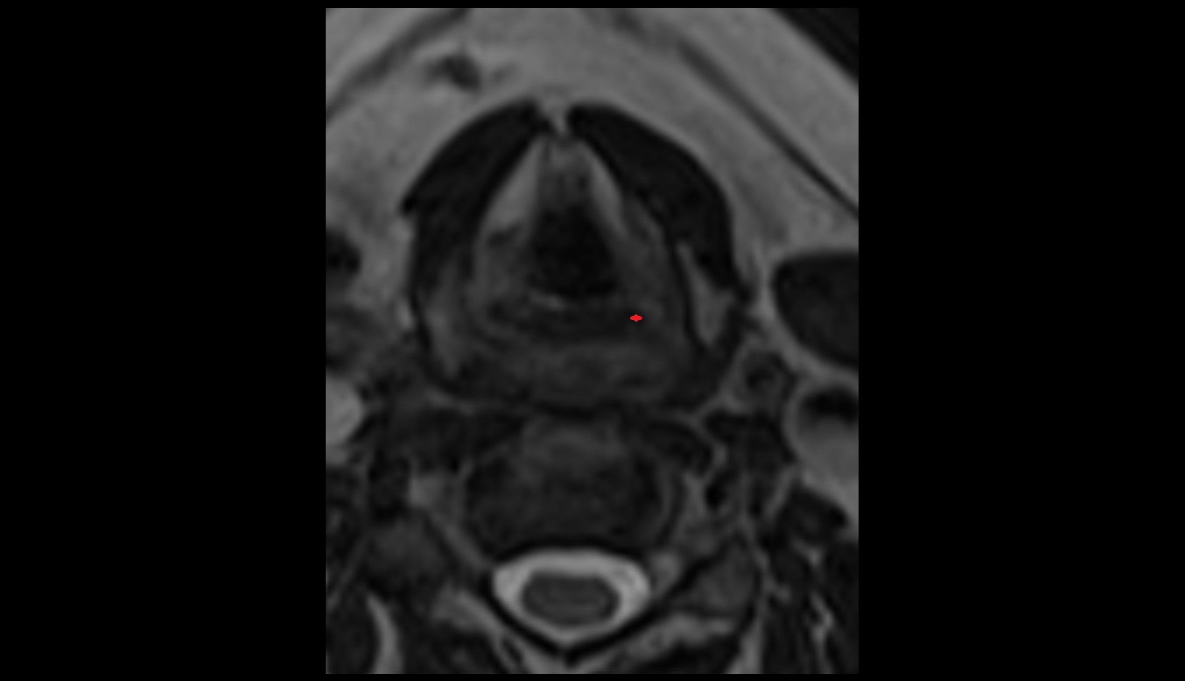 Oblique Arytenoid Muscle MRI AXIAL IMAGE