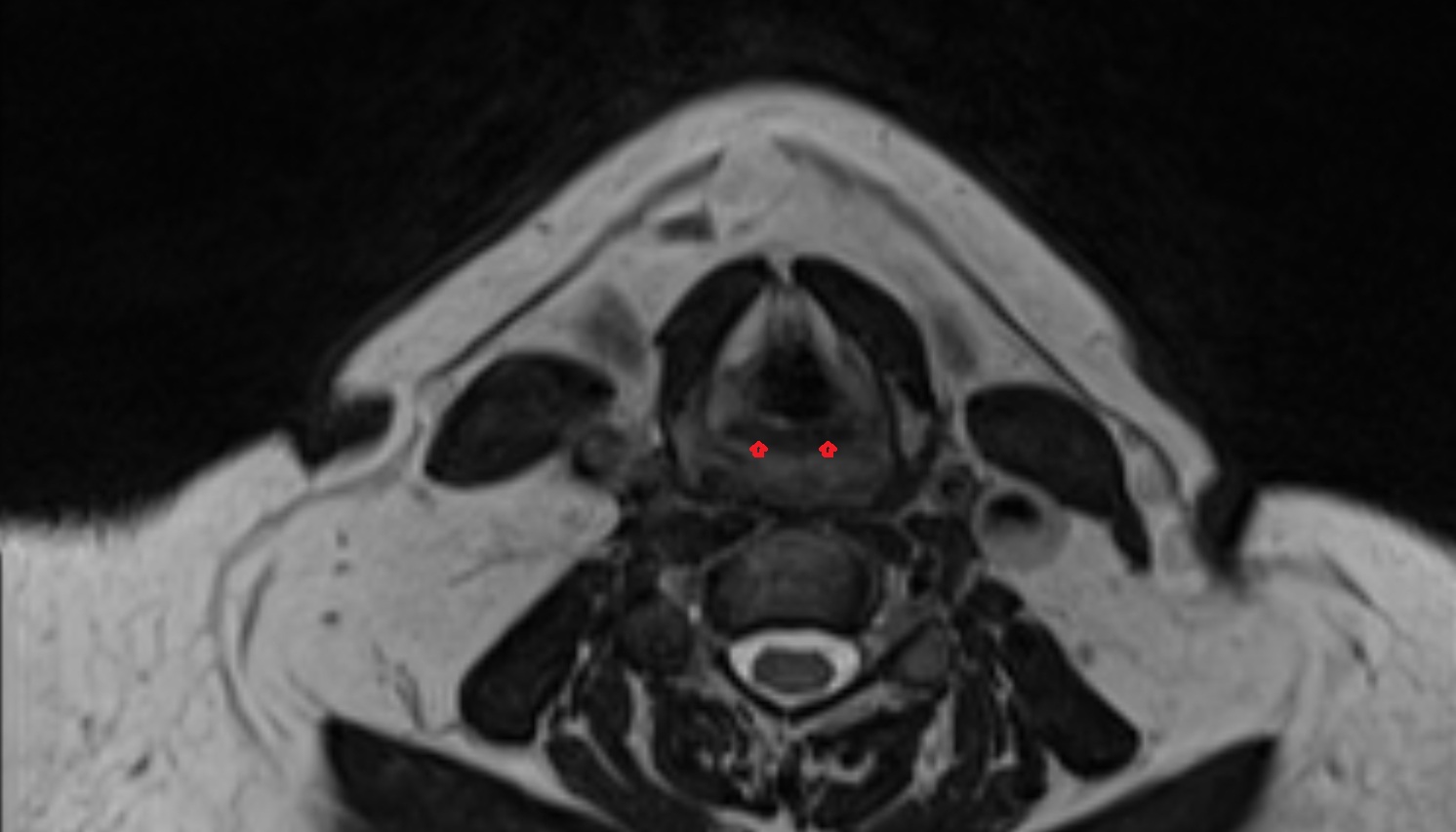 Oblique and transverse arytenoid muscles mri axial  image -img-00000-00000