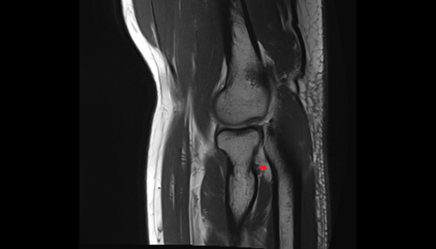 Oblique cord (ligament of Weitbrecht) of elbow  axial cross sectional anatomy 3T MRI AI enhanced radiology image -img-00000-00000