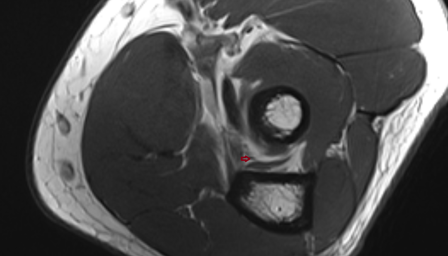 Oblique cord (ligament of Weitbrecht) of elbow  axial cross sectional anatomy 3T MRI AI enhanced radiology image -img-00000-00000_00001