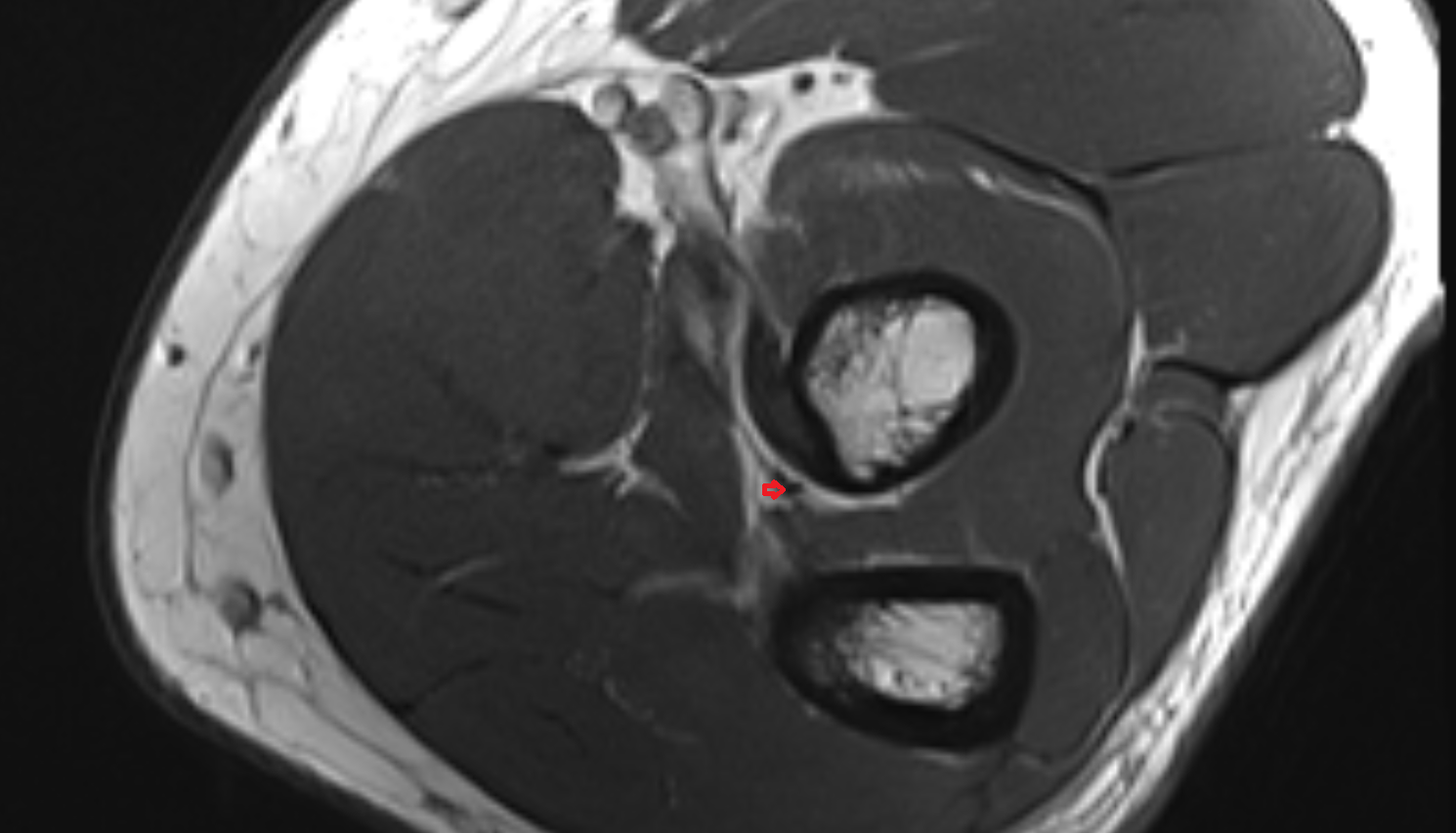 Oblique cord (ligament of Weitbrecht) of elbow  axial cross sectional anatomy 3T MRI AI enhanced radiology image -img-00000-00000_00002