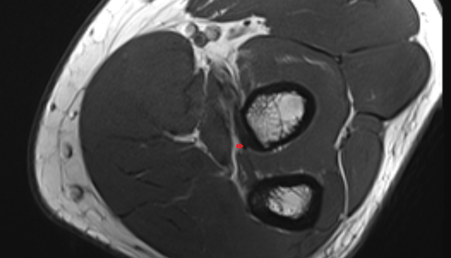 Oblique cord (ligament of Weitbrecht) of elbow  axial cross sectional anatomy 3T MRI AI enhanced radiology image -img-00000-00000_00003