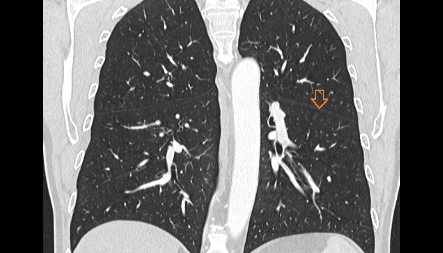 Oblique fissure of left lung  anatomy  CT coronal  image -img-00000-00000