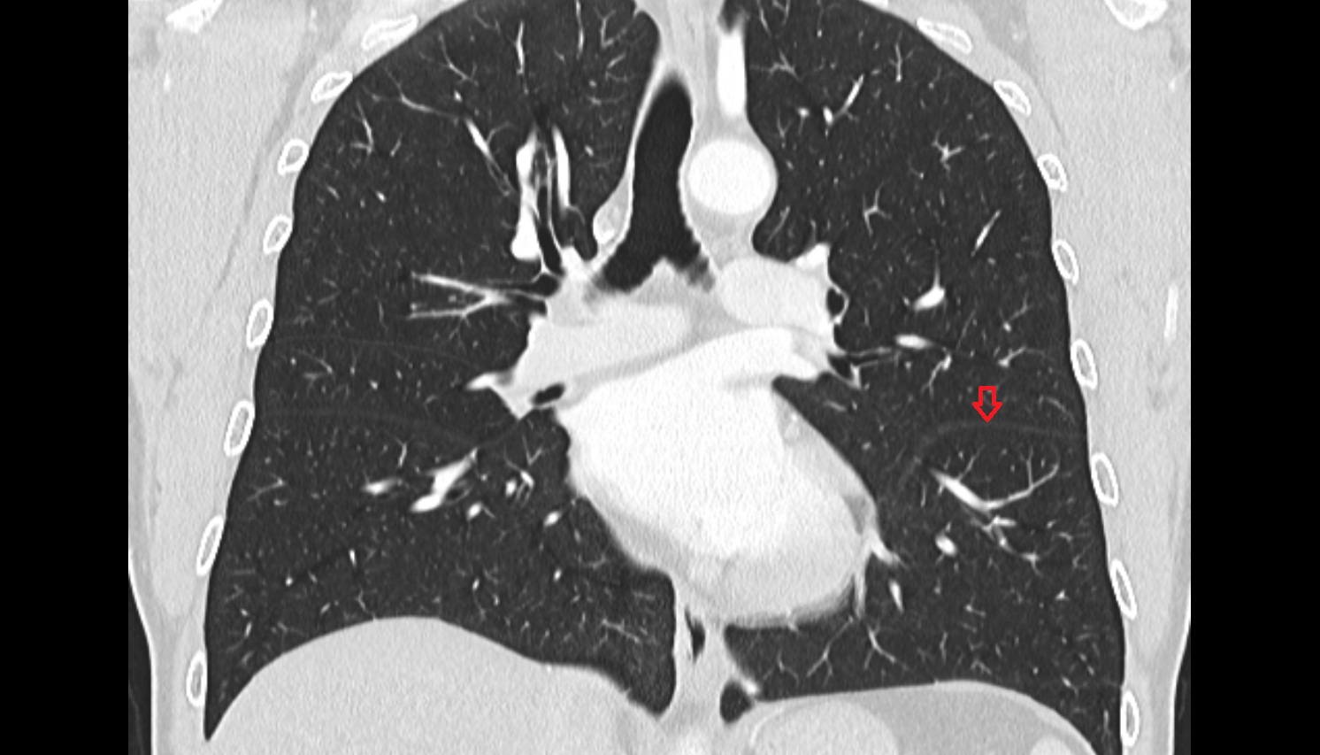 Oblique fissure of left lung  anatomy  CT coronal  image -img-00000-00000_00001
