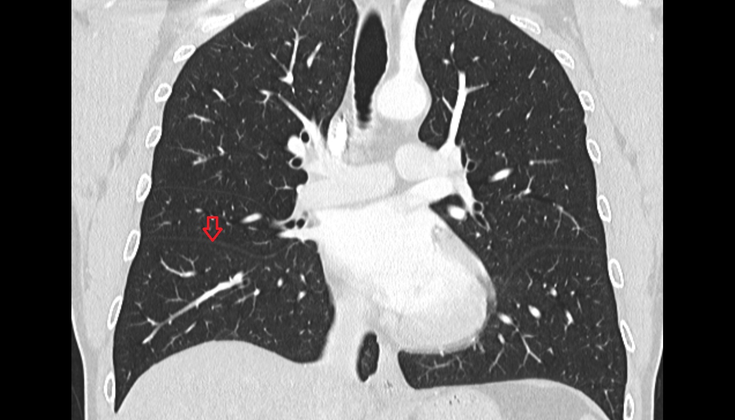 Oblique fissure of right lung  anatomy  CT coronal  image -img-00000-00000
