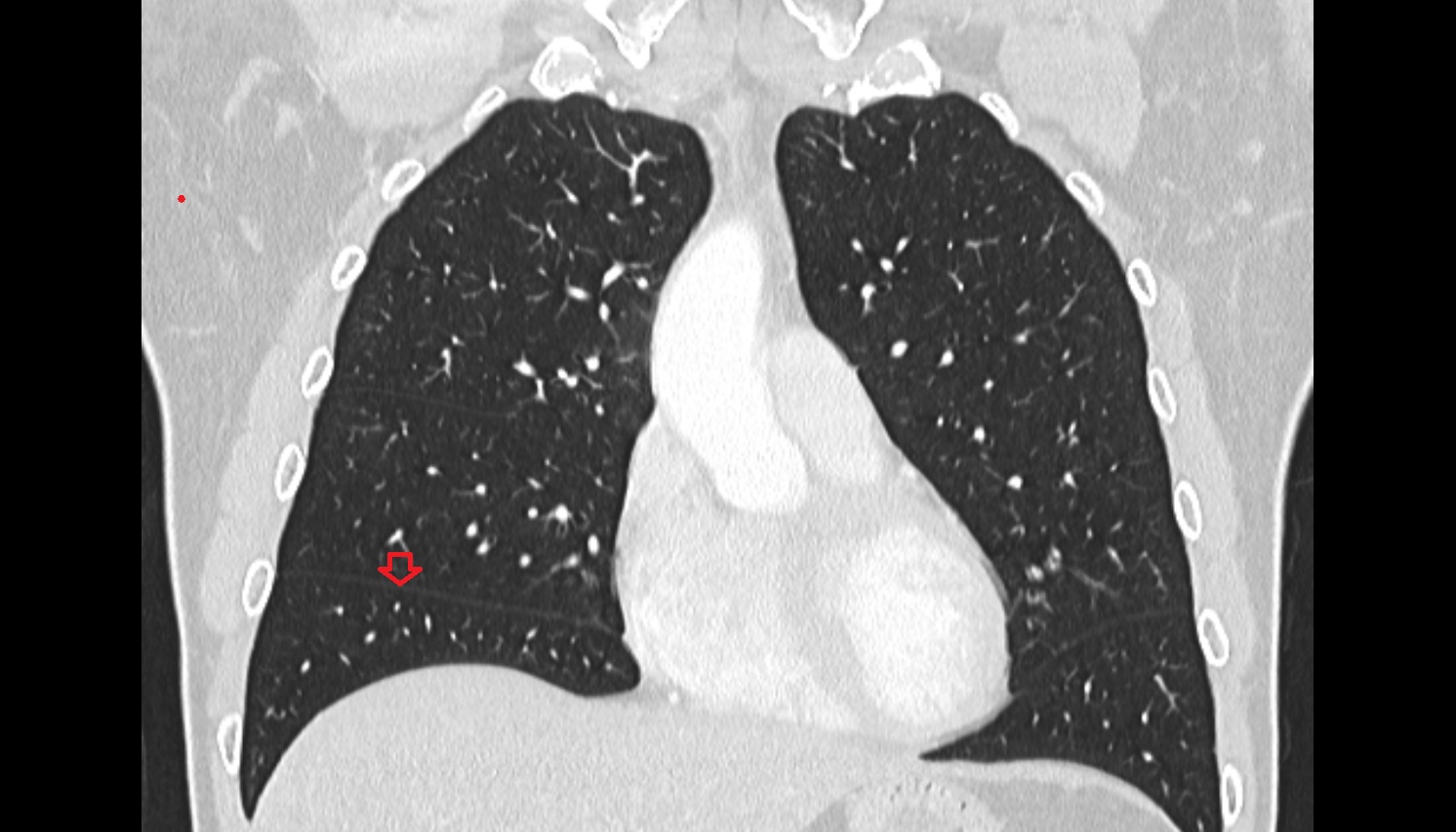 Oblique fissure of right lung  anatomy  CT coronal  image -img-00000-00000_00001