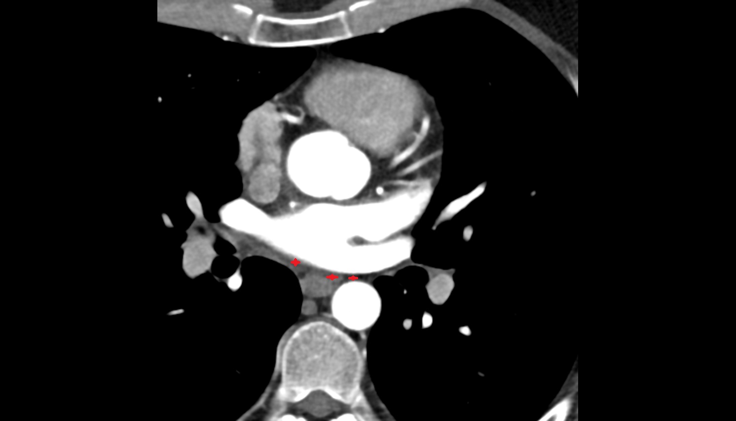 Oblique pericardial sinus  anatomy CT axial  image -img-00000-00000