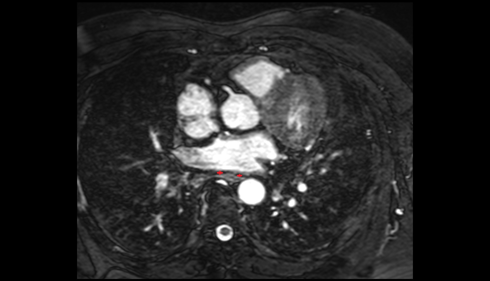 Oblique pericardial sinus mri axial image