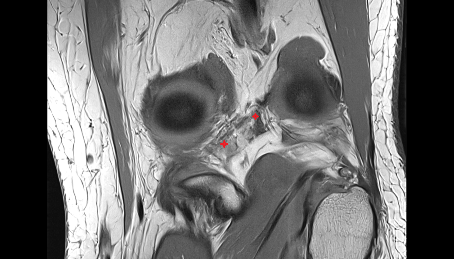 Oblique popliteal ligament (OPL) coronal cross sectional anatomy 3T MRI AI enhanced  radiology  anatomy image-img-00000-00000