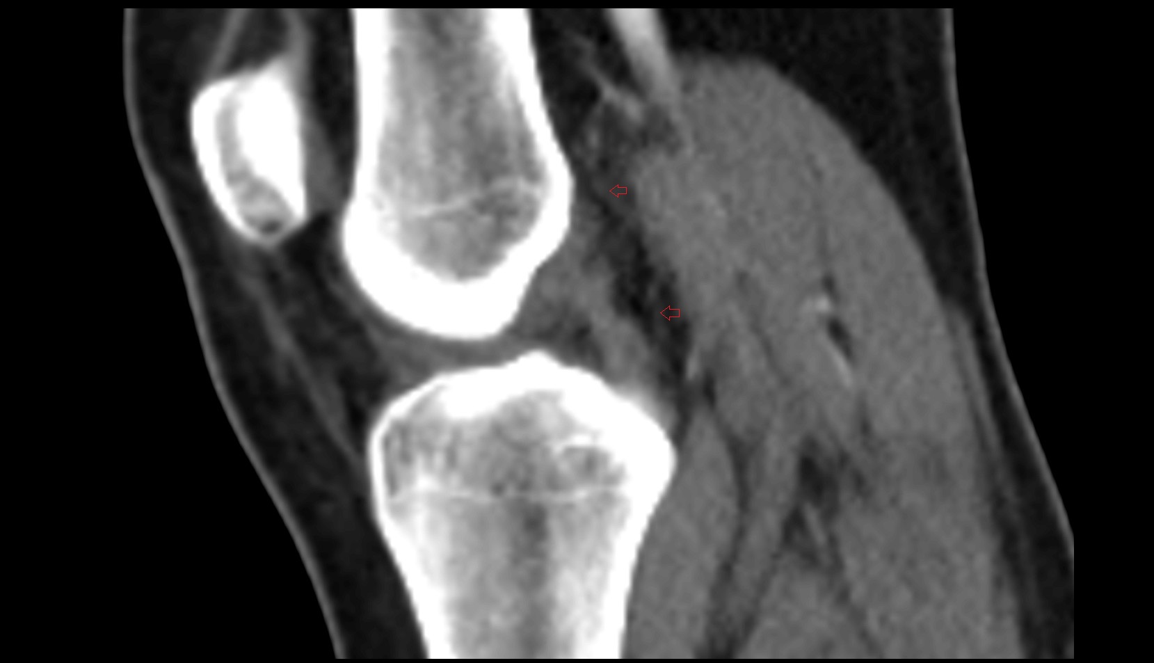 Oblique popliteal ligament (OPL) ct sag image