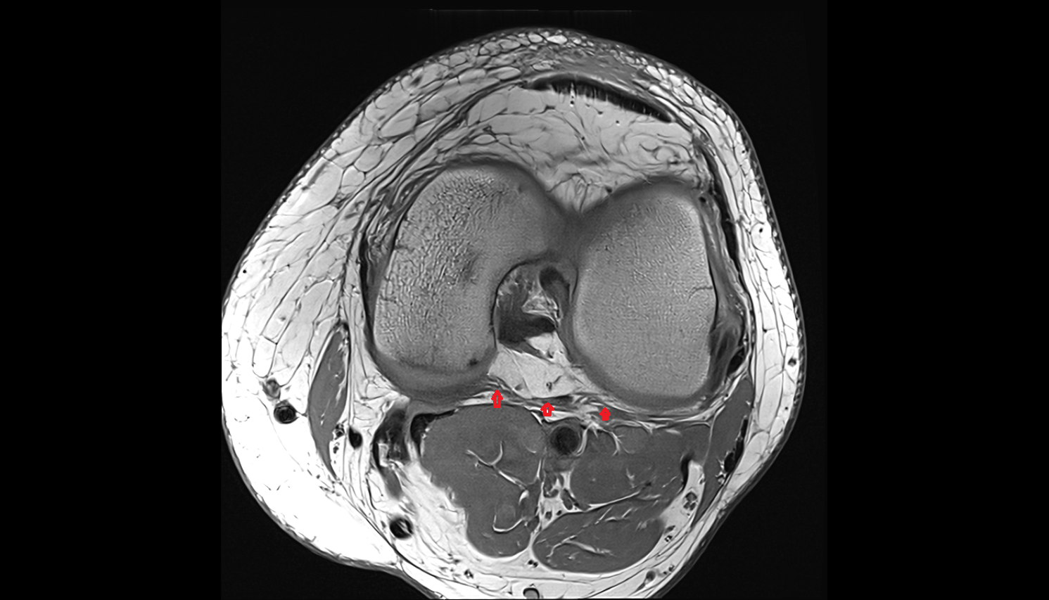 Oblique popliteal ligament (OPL) l cross sectional anatomy 3T MRI AI enhanced  radiology  anatomy image-img-00000-00000