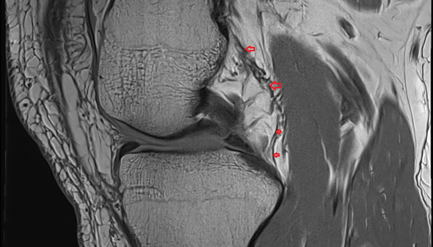 Oblique popliteal ligament (OPL) sagittal cross sectional anatomy 3T MRI AI enhanced  radiology  anatomy image-img-00000-00000