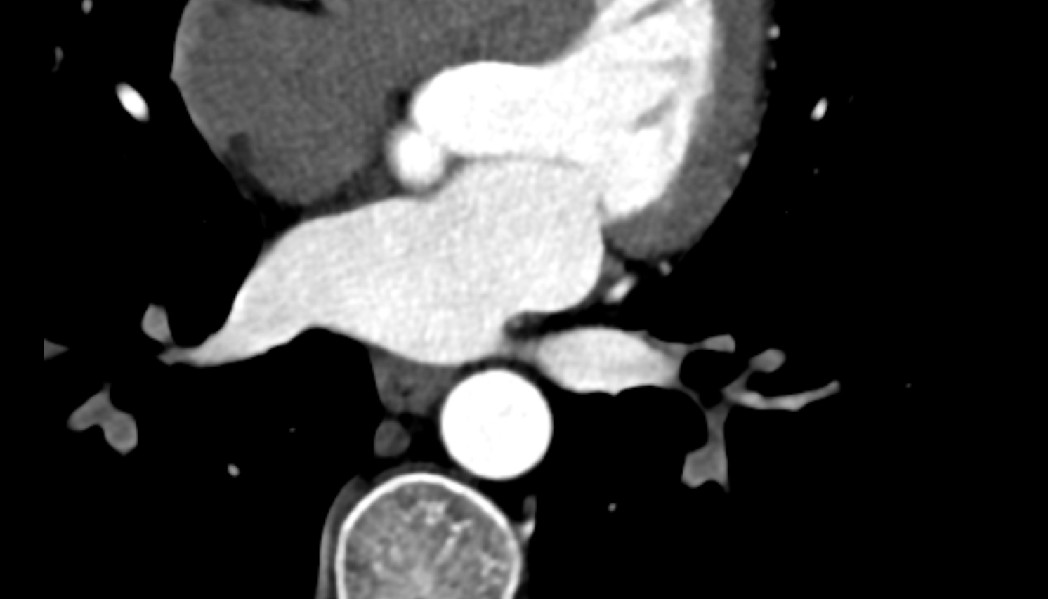 Oblique vein of left atrium anatomy  CT axial   image -img-00000-00000