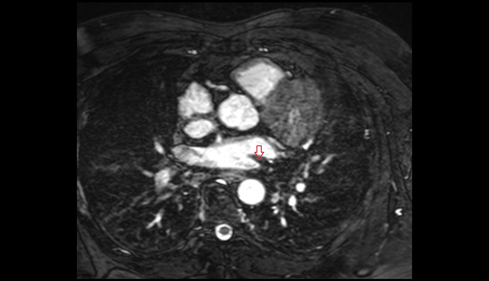 Oblique vein of left atrium mri axial image