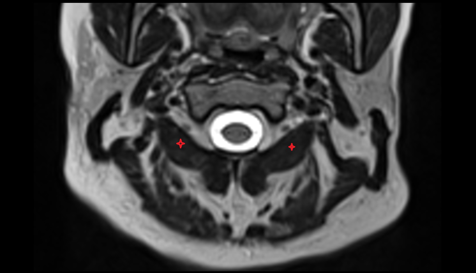 Obliquus inferior capitis muscle mri axial image