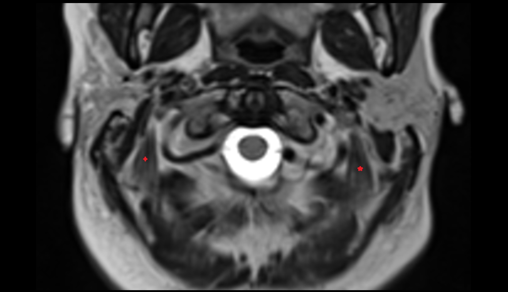 Obliquus superior capitis muscle mri axial image