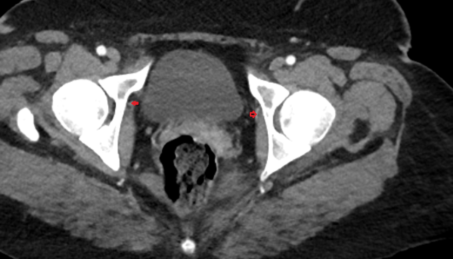 Obturator artery  CT  axial  anatomy  image-img-00000-00000_00001