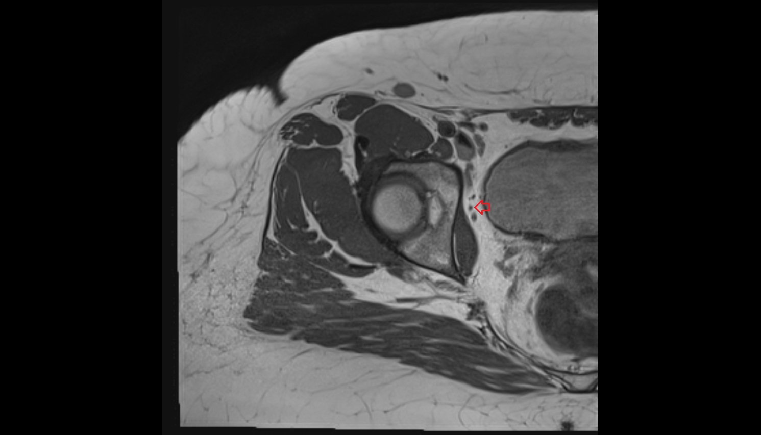 Obturator artery  MRI  axial  anatomy  image-img-00000-00000