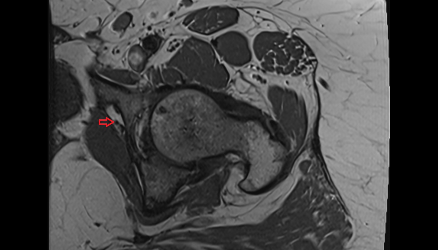 Obturator artery  MRI  axial  anatomy  image-img-00000-00000_00001