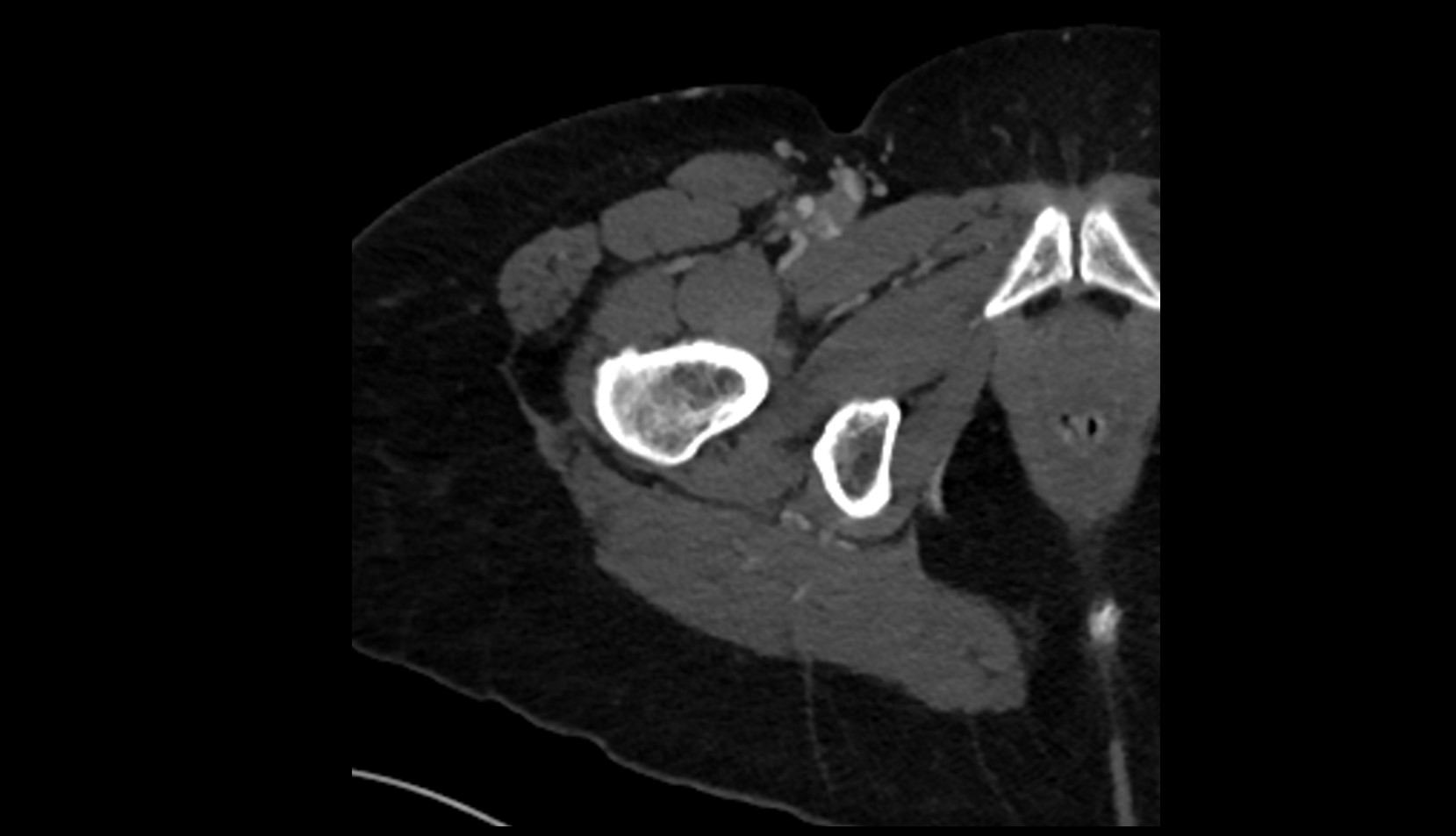 Obturator externus muscle CT axial image