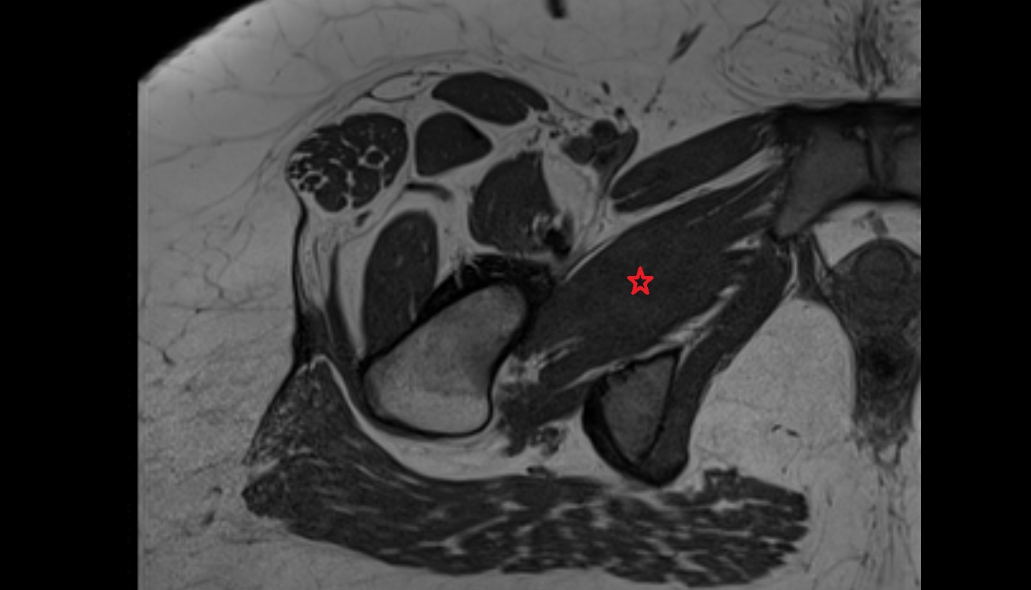 Obturator externus muscle  CT  axial  anatomy  image-img-00000-00000
