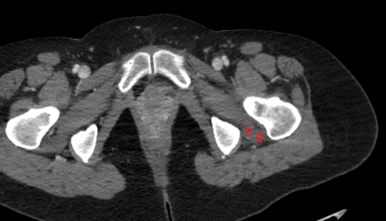 Obturator externus tendon  CT  axial  anatomy  image-img-00000-00000