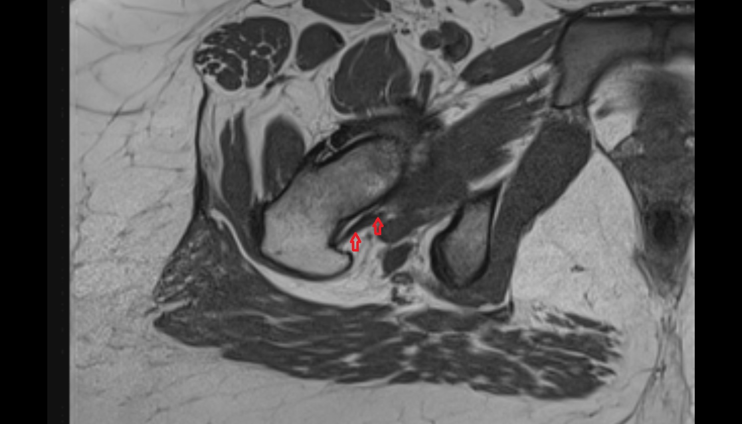 Obturator externus tendon  MRI  axial  anatomy  image-img-00000-00000