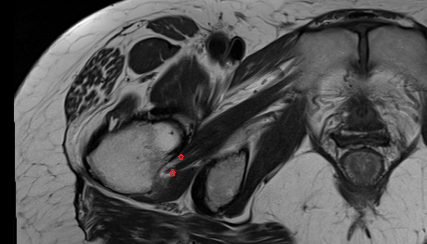 Obturator externus tendon  MRI  axial  anatomy  image-img-00000-00000_00001