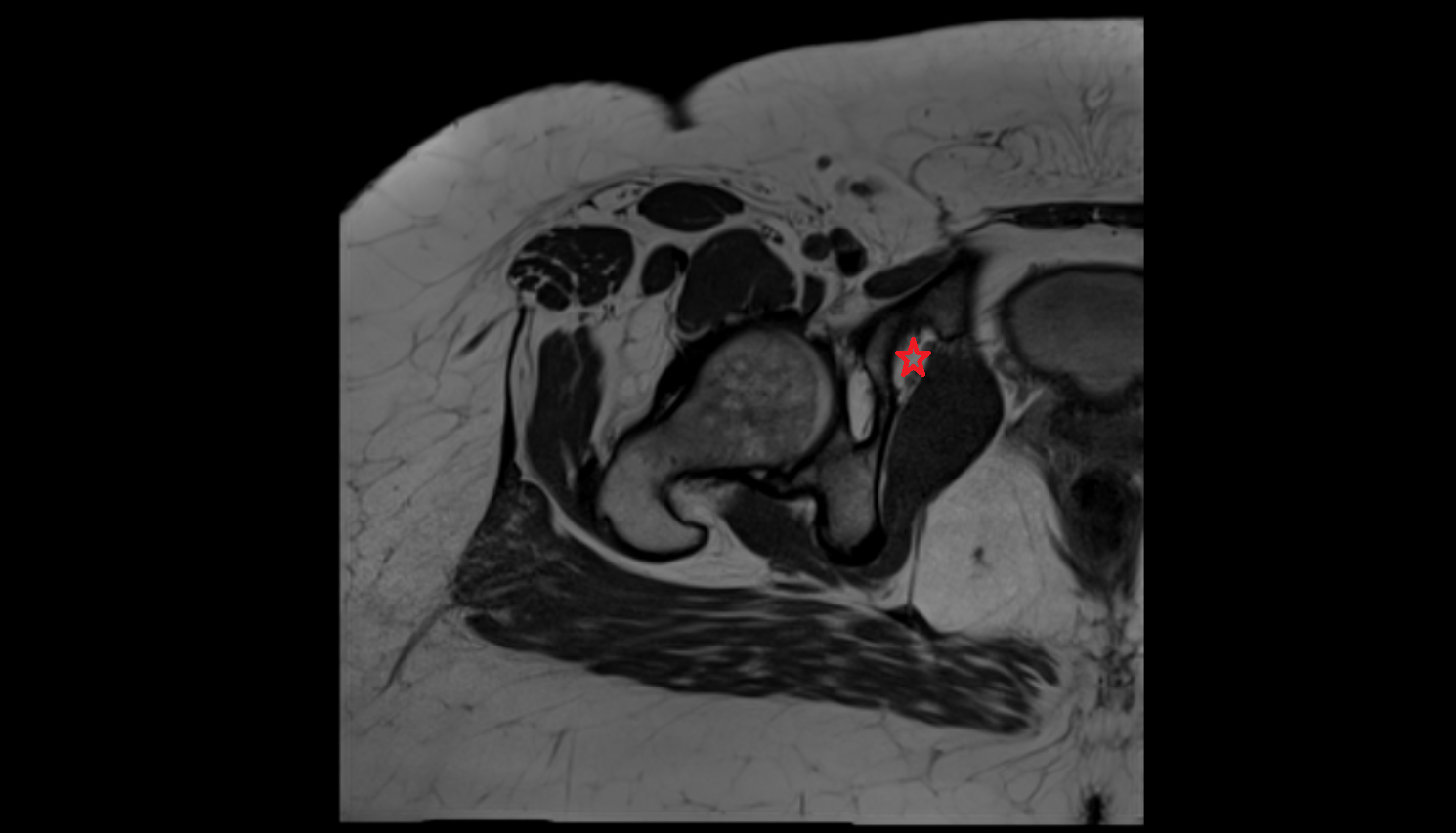 Obturator foramen  mri  anatomy  Location and Imaging Appearance  -img-00000-00000