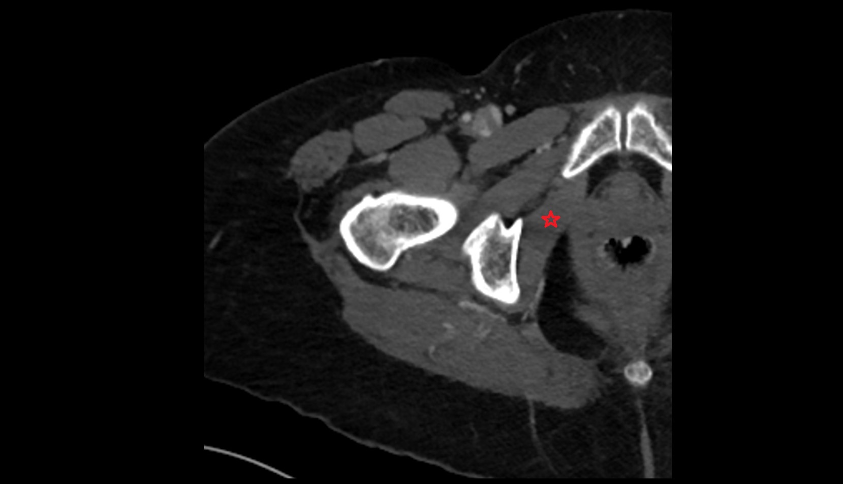 Obturator internus muscle CT axial image