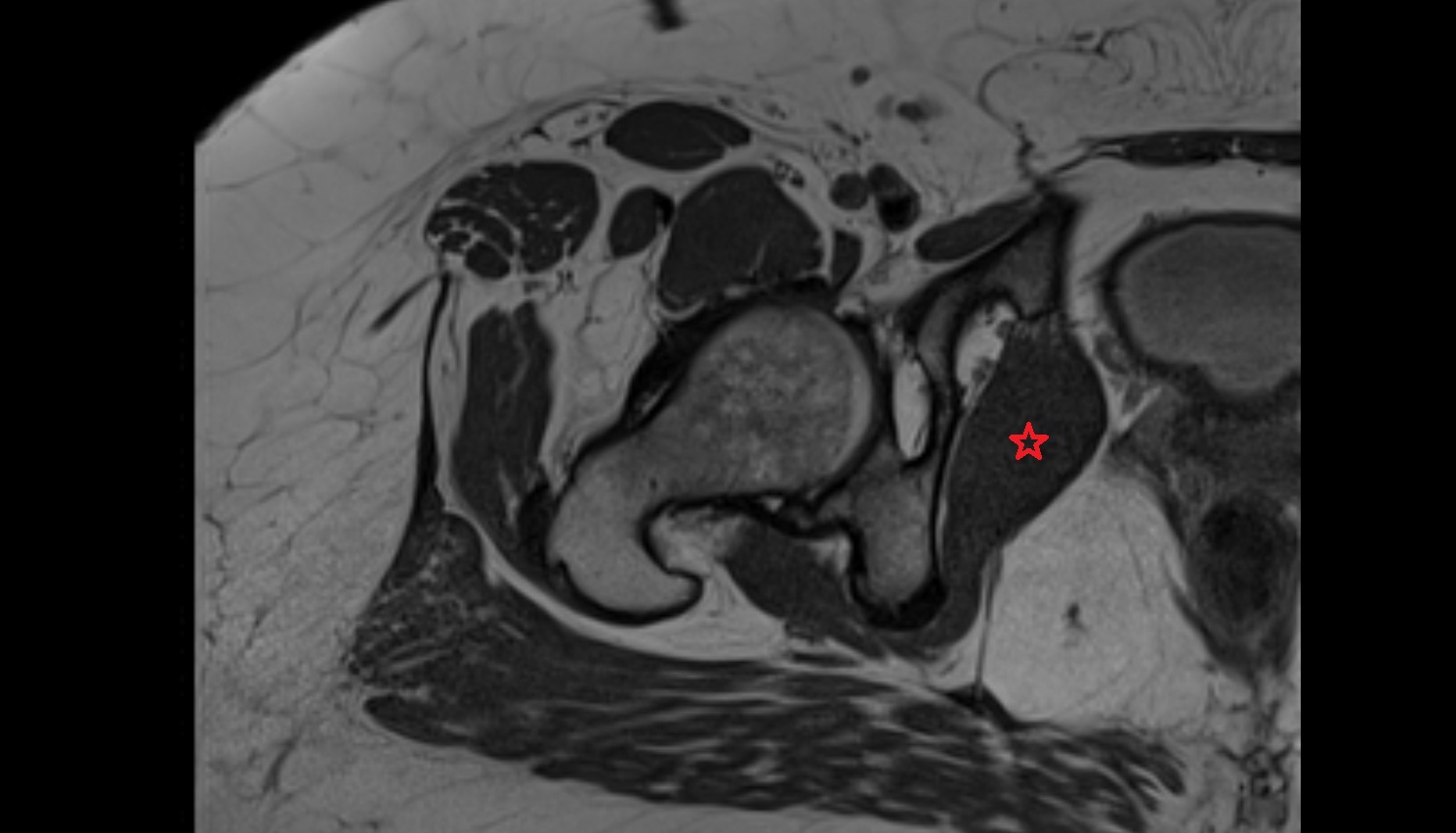 Obturator internus muscle MRI  axial  anatomy  image-img-00000-00000