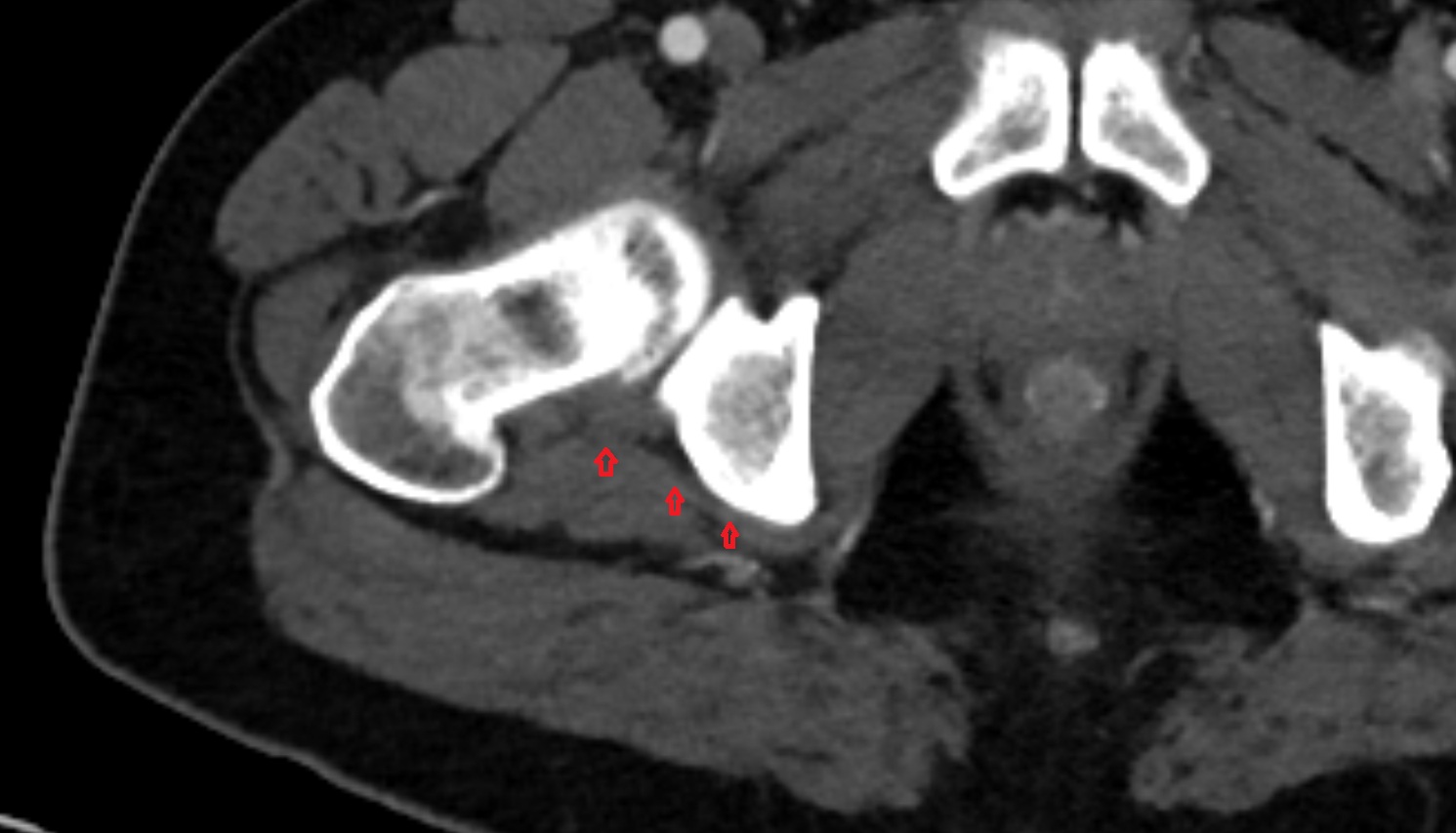 Obturator internus tendon CT  axial  anatomy  image-img-00000-00000