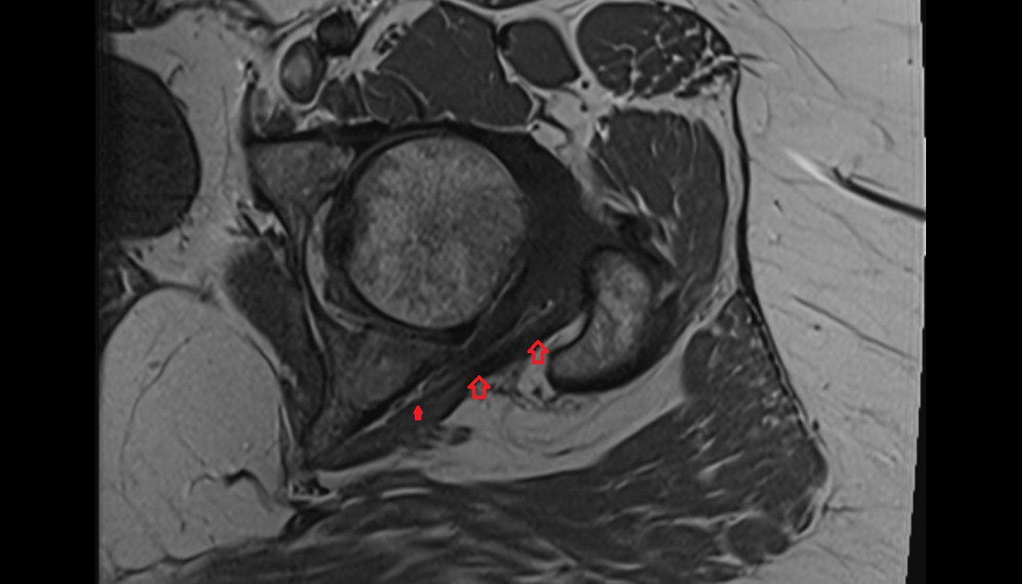 Obturator internus tendon   MRI axial  anatomy  image-img-00000-00000