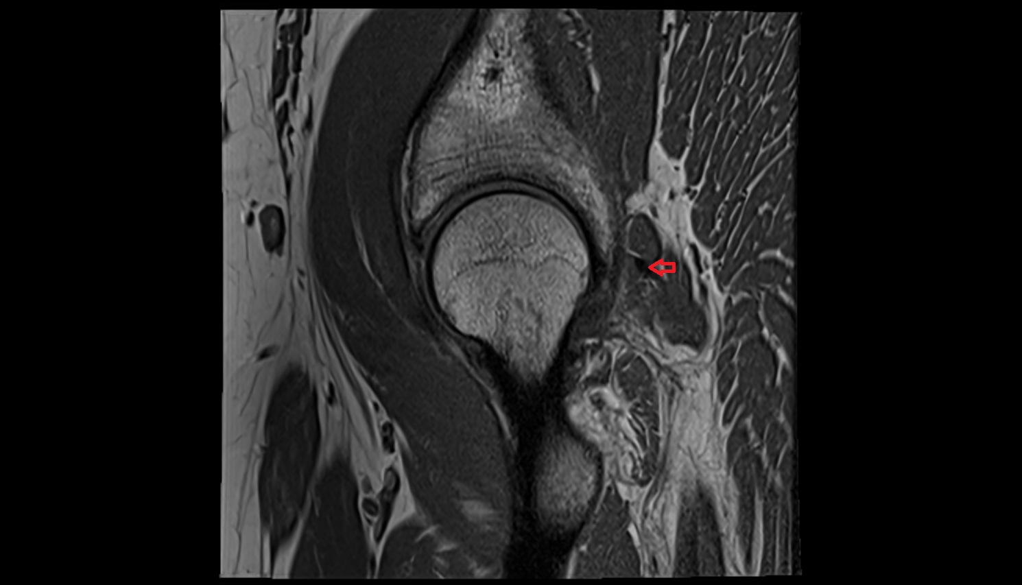 Obturator internus tendon  MRI sag anatomy image-img-00000-00000