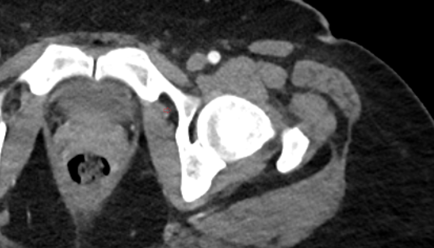 Obturator lymph nodes ct  axial  anatomy  image-img-00000-00000