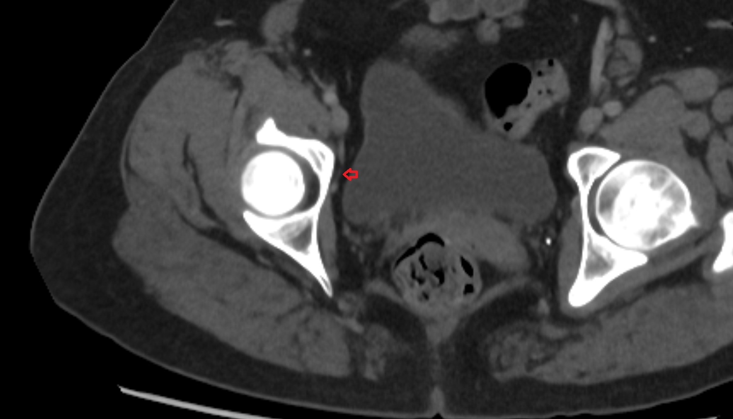 Obturator nerve  CT  axial  anatomy  image-img-00000-00000_00002