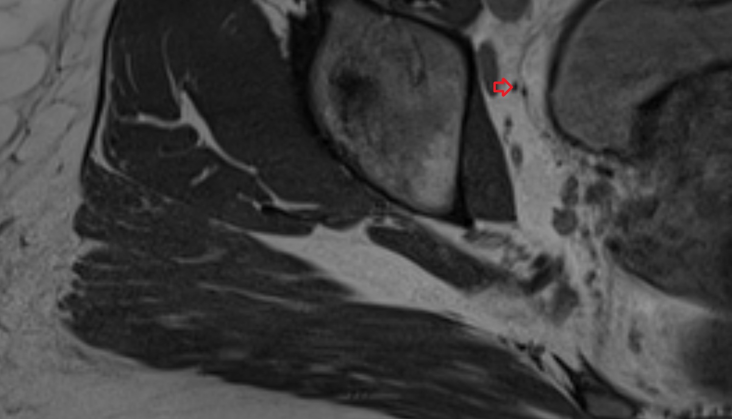 Obturator nerve  MRI  axial  anatomy  image-img-00000-00000_00002