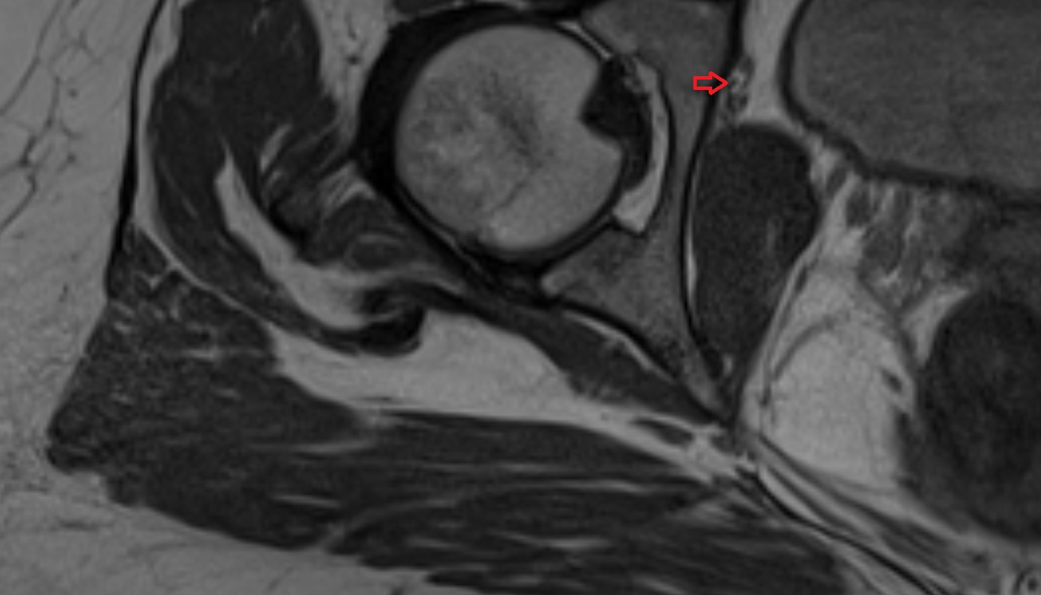 Obturator nerve  MRI  axial  anatomy  image-img-00000-00000_00003
