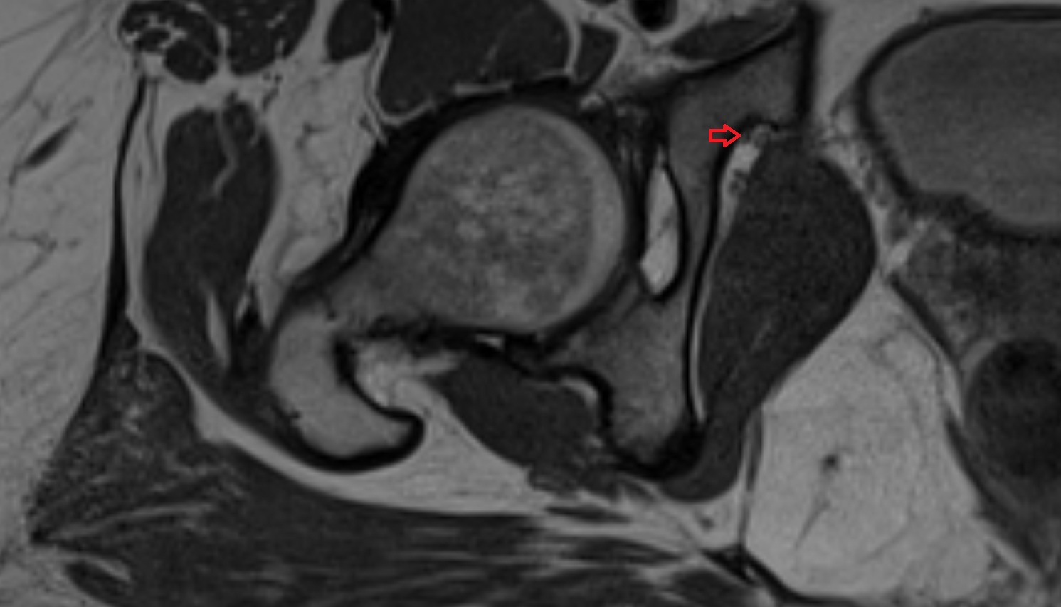 Obturator nerve  MRI  axial  anatomy  image-img-00000-00000_00004