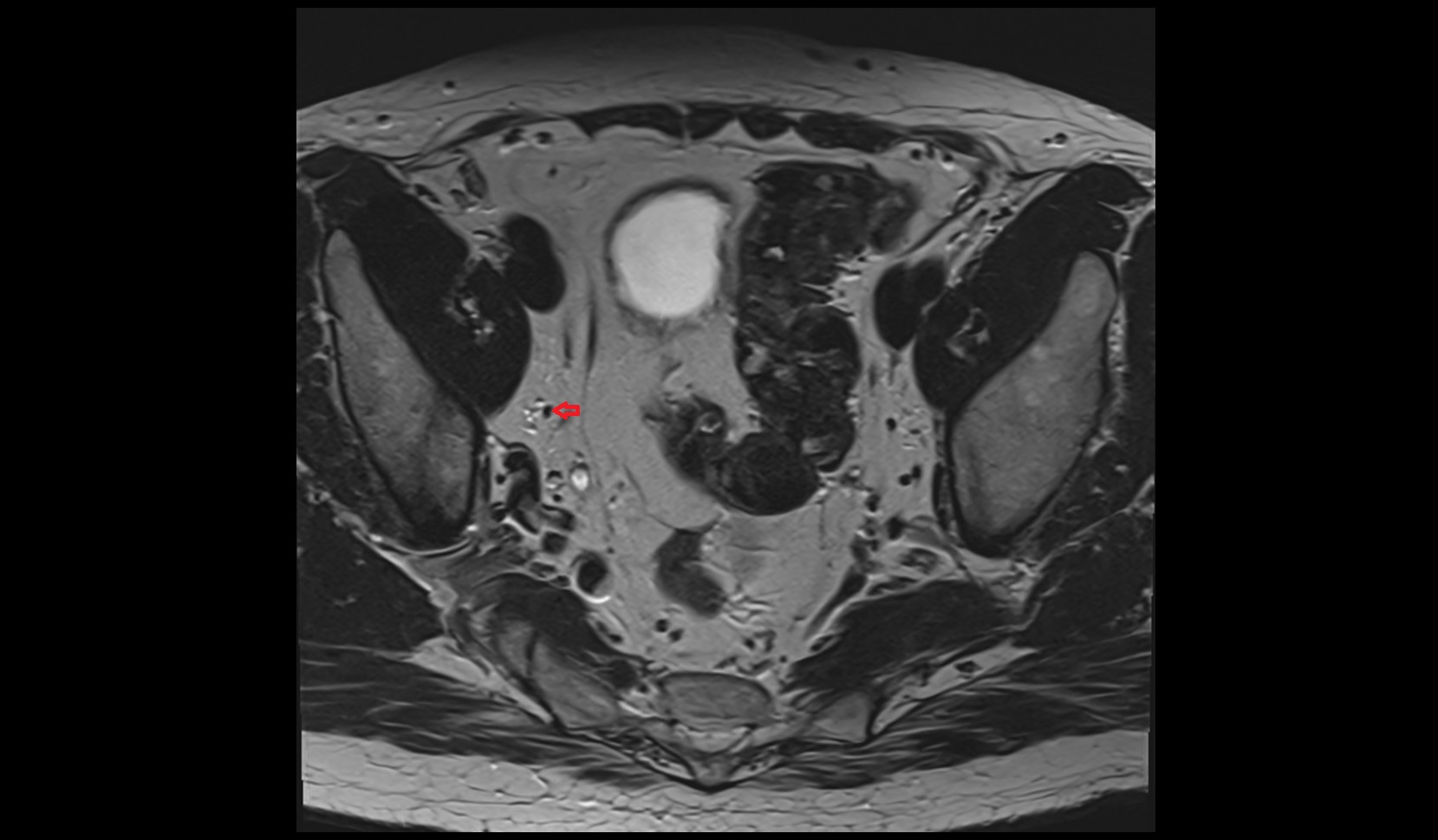 Obturator nerve male