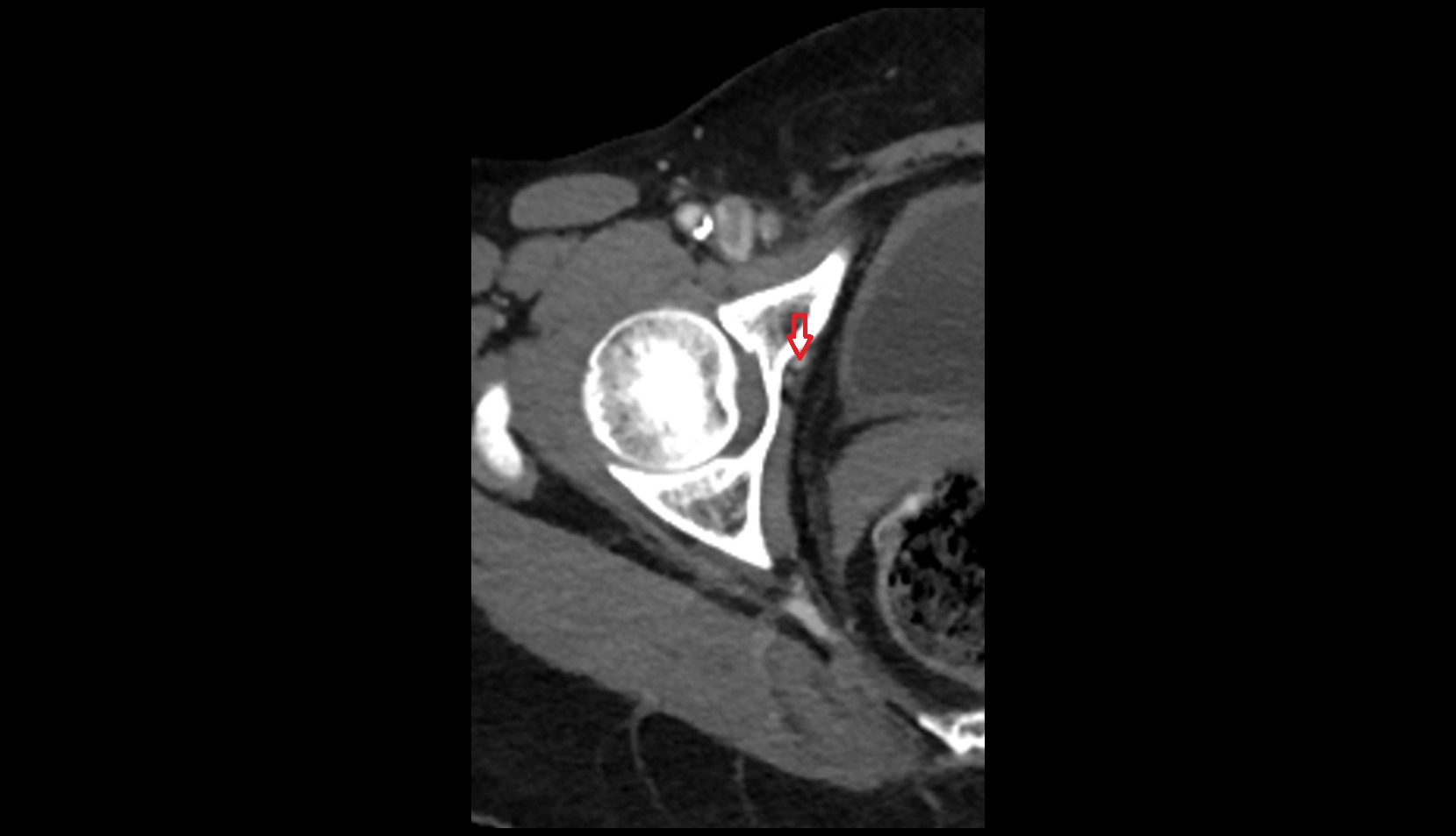 Obturator vein ct axial